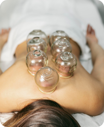 Cupping an Alternate Solution for Soreness & Pain