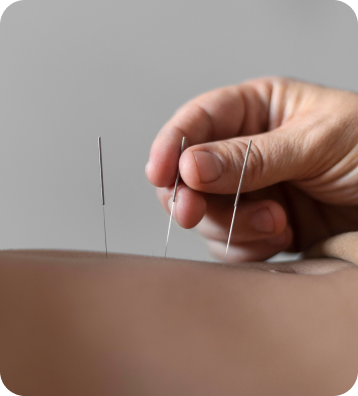 a person receiving acupuncture treatment